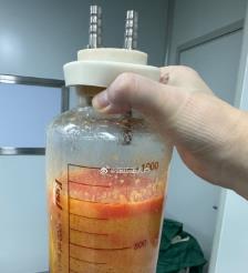 阿勒泰水动力吸脂手术要做多久？